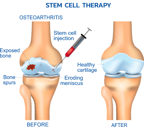 img-Stemcell-and-knee